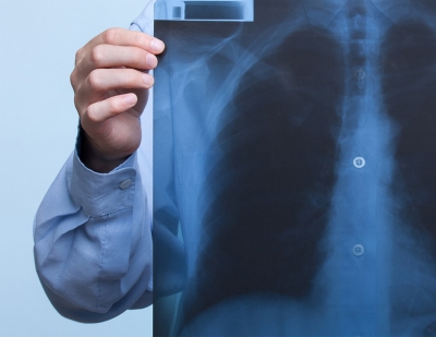 Campanie de conştientizare a luptei împotriva cancerului pulmonar