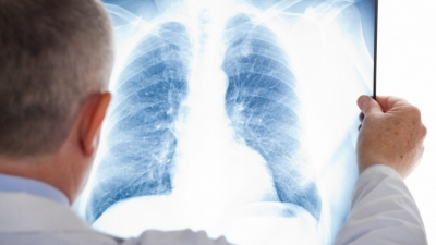 Ministerul Sănătăţii: Guvernul a aprobat sumele necesare acoperirii plăţii TVA pentru un program privind controlul tuberculozei
