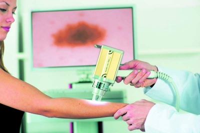 Scoaterea aluniţelor prin intervenţia cu laser prezintă dezavantaje