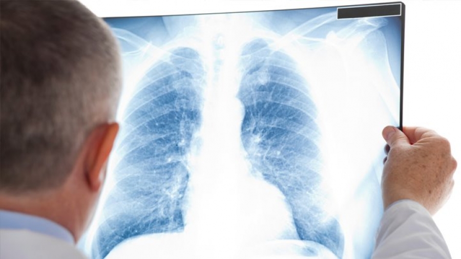Românii pot afla dacă au risc de a dezvolta cancer pulmonar cu ajutorul unui test online