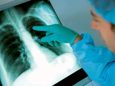 În România, mortalitatea prin tuberculoză s-a înjumătăţit în ultimii 13 ani