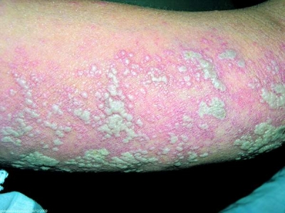 Două treimi din populaţia mondială sub 50 de ani are herpes