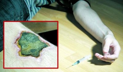 Efectele cumplite ale drogului Krokodil
