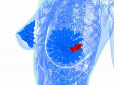 Cancerul de sân: Aceeaşi rată de supravieţuire la simpla extirpare a tumorii şi la dubla mastectomie