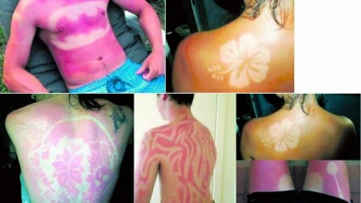 Arsurile solare în scop artistic, o practică la modă, dar foarte periculoasă