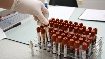 Un test bazat pe analize de sânge şi vârstă preconizează riscul de maladii cronice