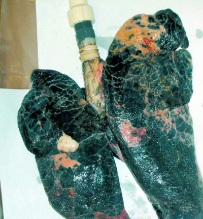 Leziunile pulmonare vor putea fi vindecate