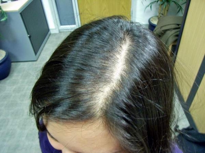 Una din trei femei îşi pierde părul în urma curelor de slăbire