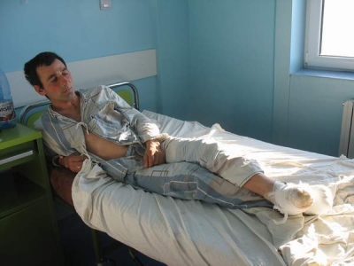 10 degete amputate de la degerături