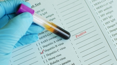 Peste 800.000 de români sunt infectaţi cu virusul hepatitei B