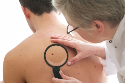 Cancerul de piele: experţii pun la îndoială utilitatea screening-ul anual