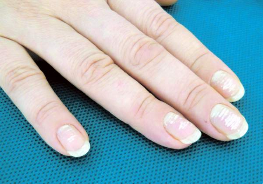 Petele albe pe unghii nu sunt cauzate de lipsa de calciu