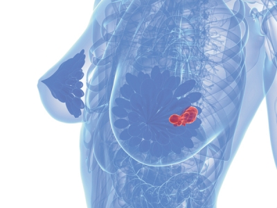 Un simplu test asupra nivelului de metal din sânge ar putea detecta cancerul de sân