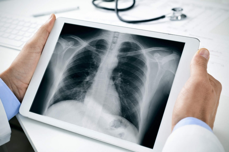 Leziunile pulmonare descoperite la pacienţi decedaţi dezvăluie informaţii despre "COVID-ul de lungă durată"
