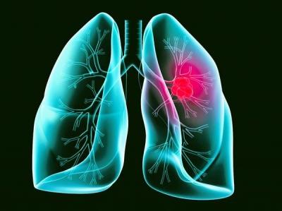 Peste 30.000 de români mor anual de cancer pulmonar