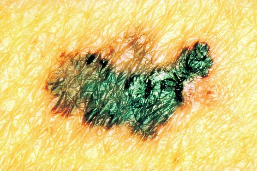 Singurul medicament personalizat destinat tratamentului melanomului metastatic, disponibil şi în România