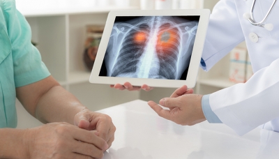 CT perfomant pentru analiza nodulilor pulmonari, la Spitalul TBC Galaţi