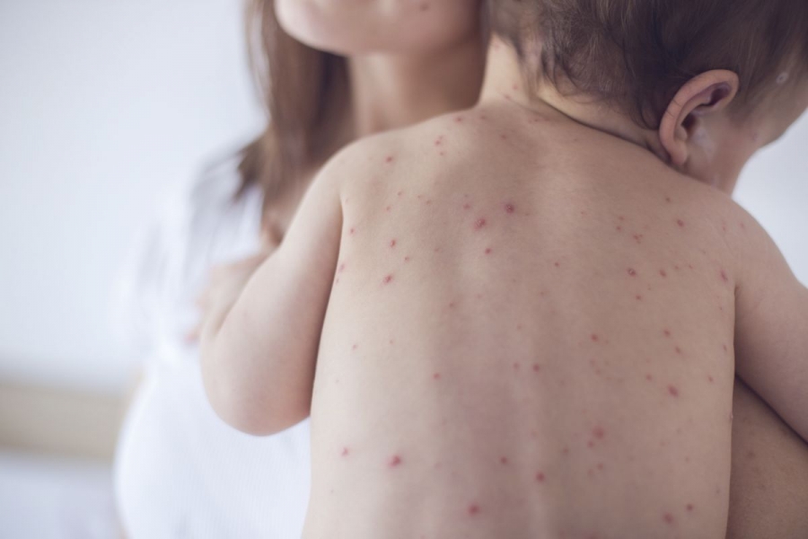 23 de copii din Galaţi au rujeolă. 10 copii internaţi la Spitalul de Boli Infecţioase, un sugar transferat la Iaşi