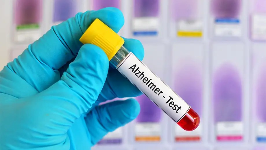 Test sangvin de depistare a maladiei Alzheimer la domiciliu