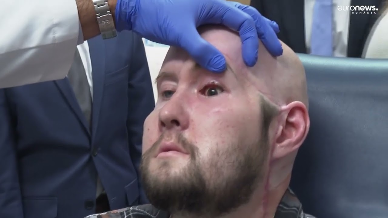 Premieră mondială în chirurgie: Primul transplant al unui ochi complet a fost realizat în Statele Unite