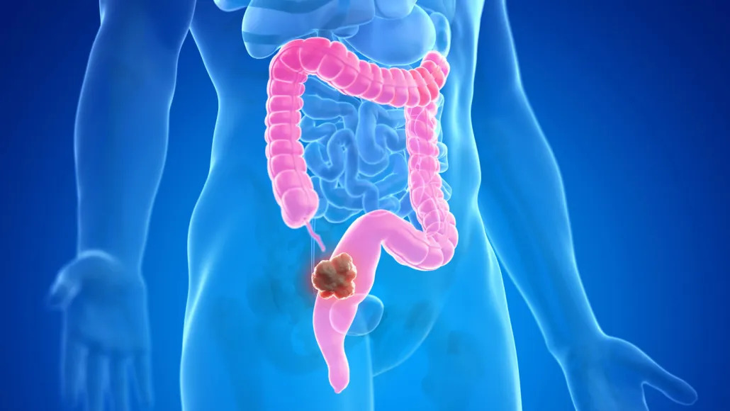 Studiu polonez: Inteligenţa artificială poate reduce abilitatea medicilor de a detecta cancerul de colon