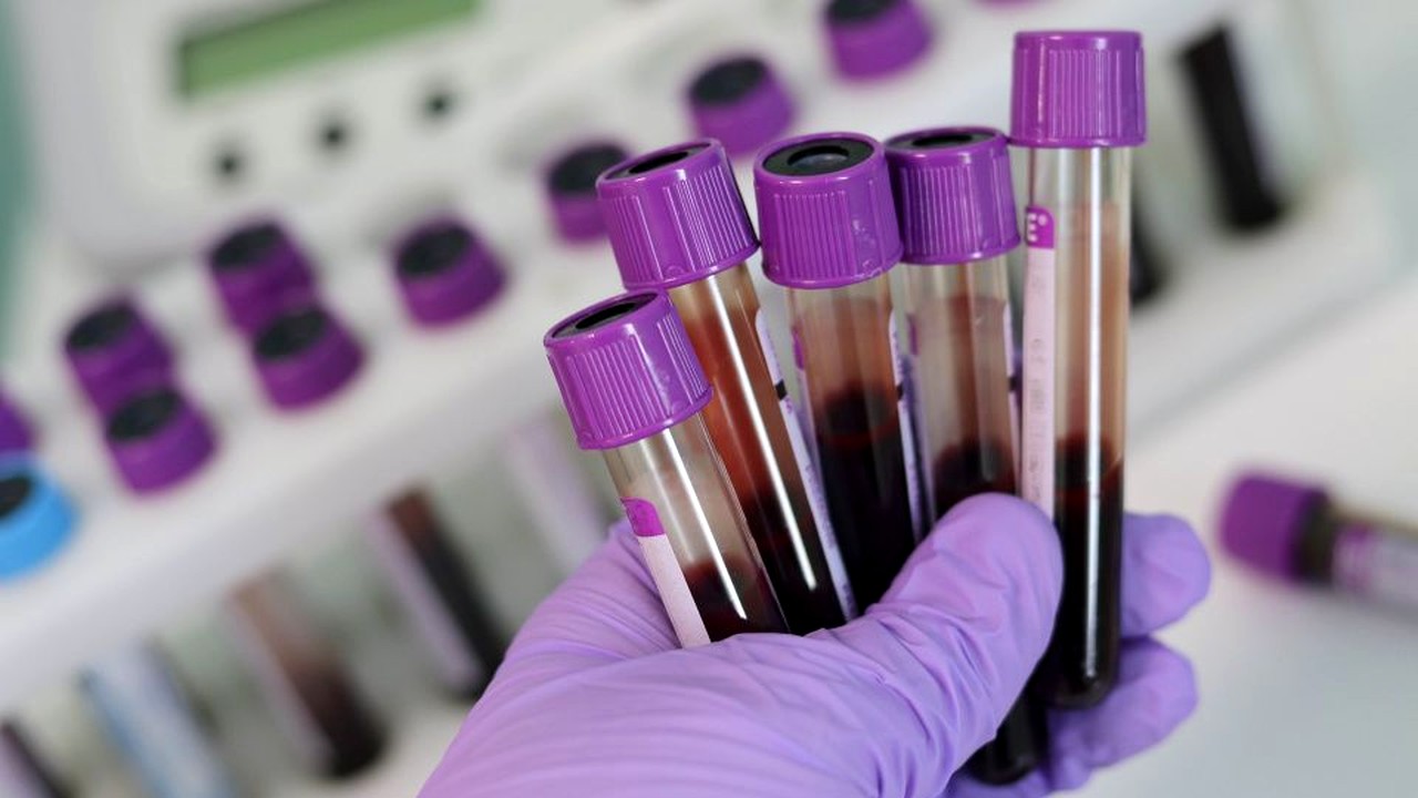 Un simplu test de sânge ar putea revoluţiona depistarea cancerului ovarian