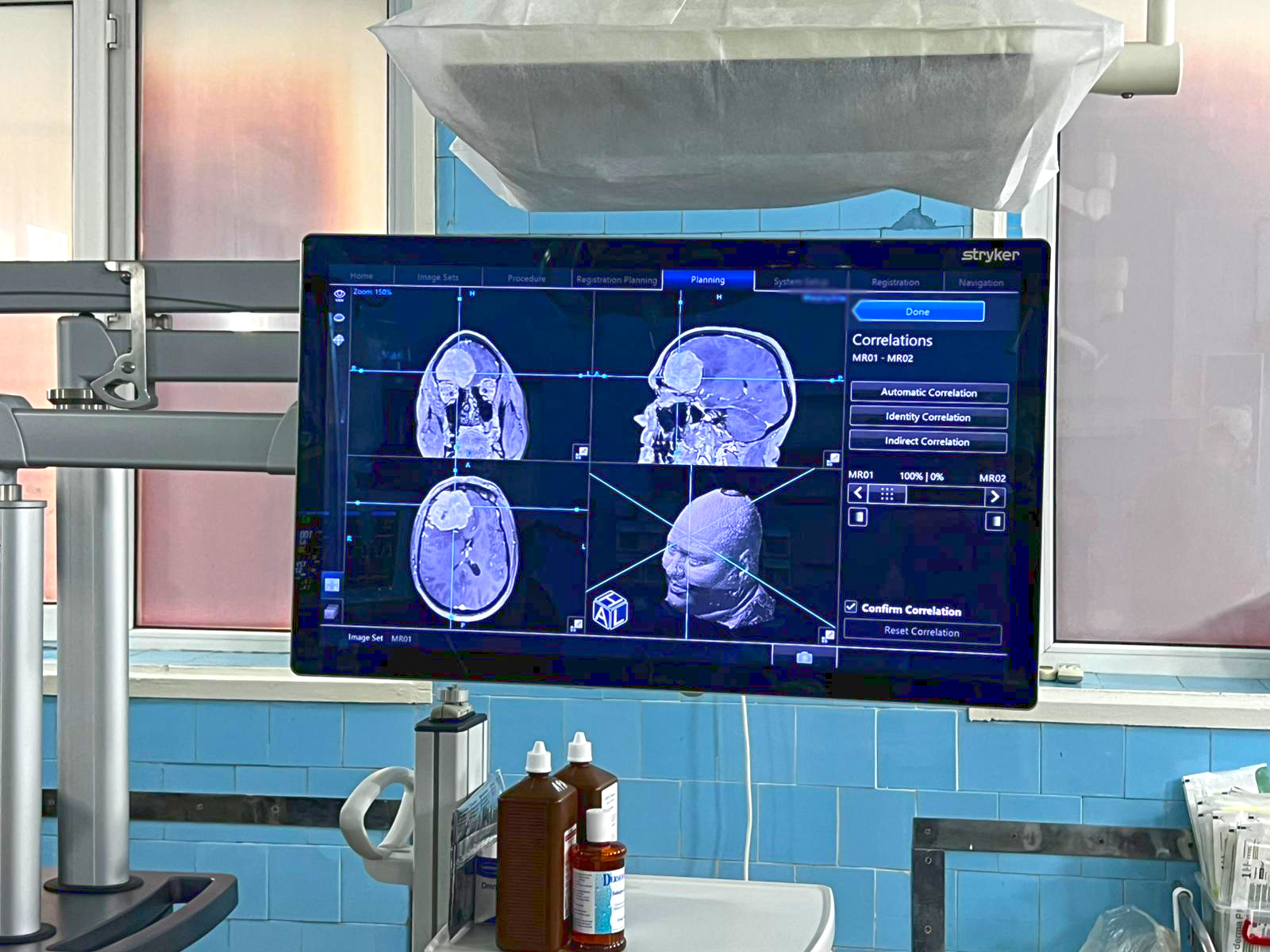 Galaţi: Prima operaţie pe creier realizată cu ajutorul Sistemului de Neuronavigaţie, la Spitalul Judeţean